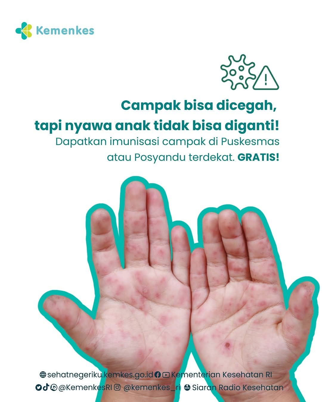 Campak merebak, lengkapi imunisasi anak